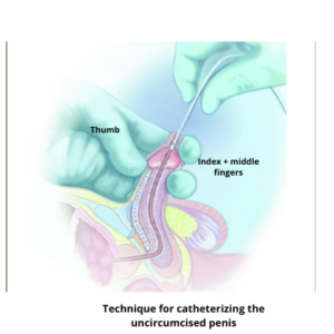 catheterization of circumcised penis